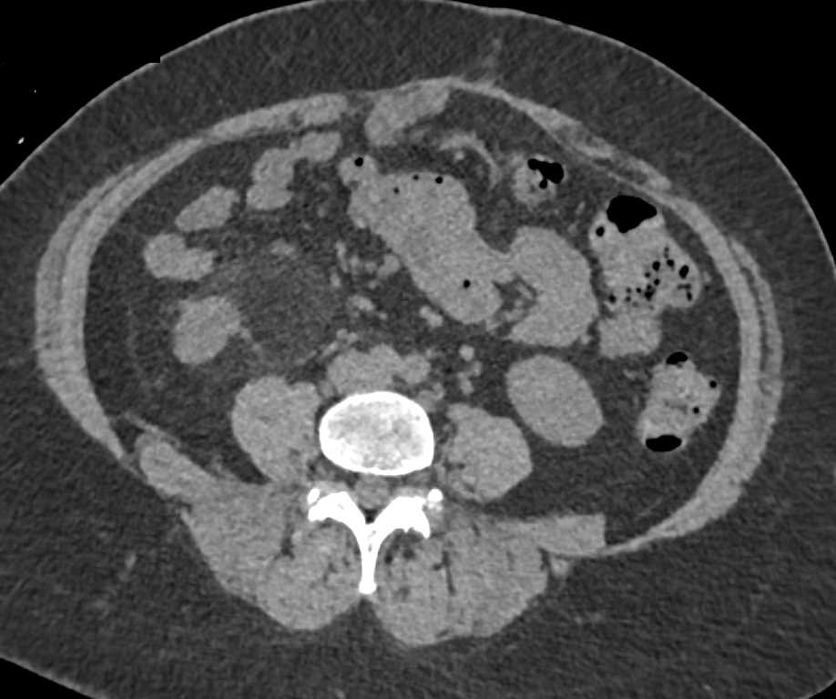 Angiomyolipoma Right Kidney Simulates a Liposarcoma Near the Right Kidney - CTisus CT Scan