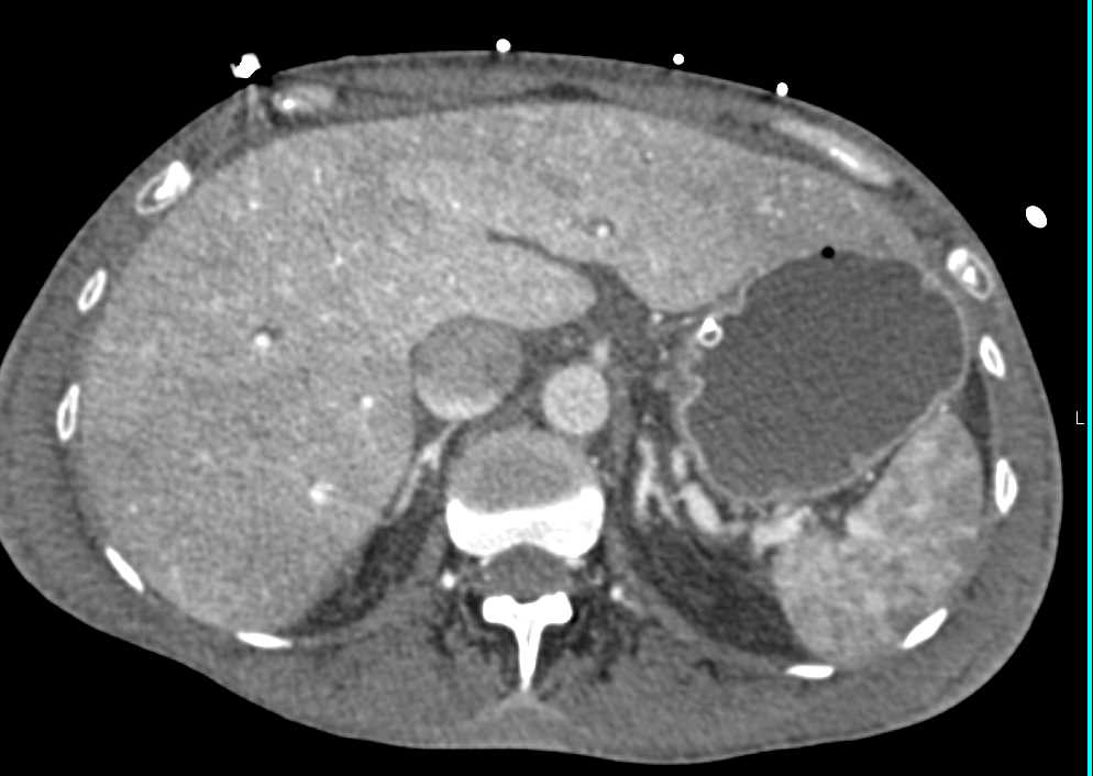 Enhancing Adrenal Glands in a Hypotensive Patient who Incidentally had Superior Mesenteric Artery (SMA) Syndrome - CTisus CT Scan