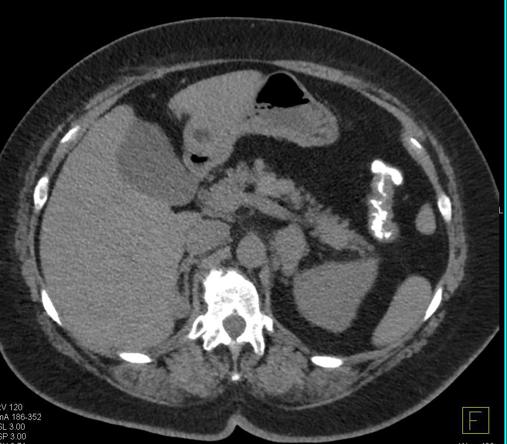 Recurrent Renal Cell Carcinoma Metastatic to the Pancreas, Contralateral Adrenal and Adenopathy - CTisus CT Scan