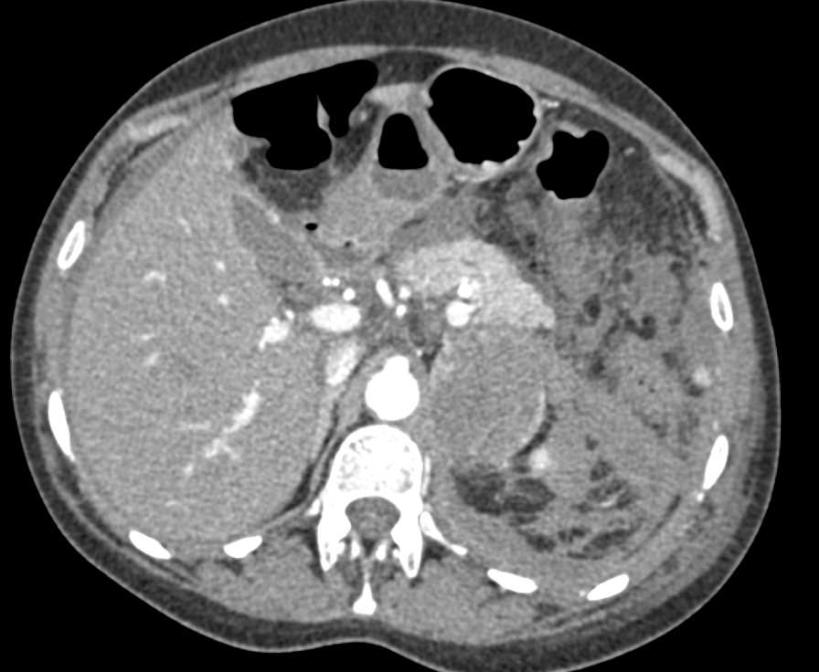 Left Adrenal Bleed with Hemoperitoneum - CTisus CT Scan