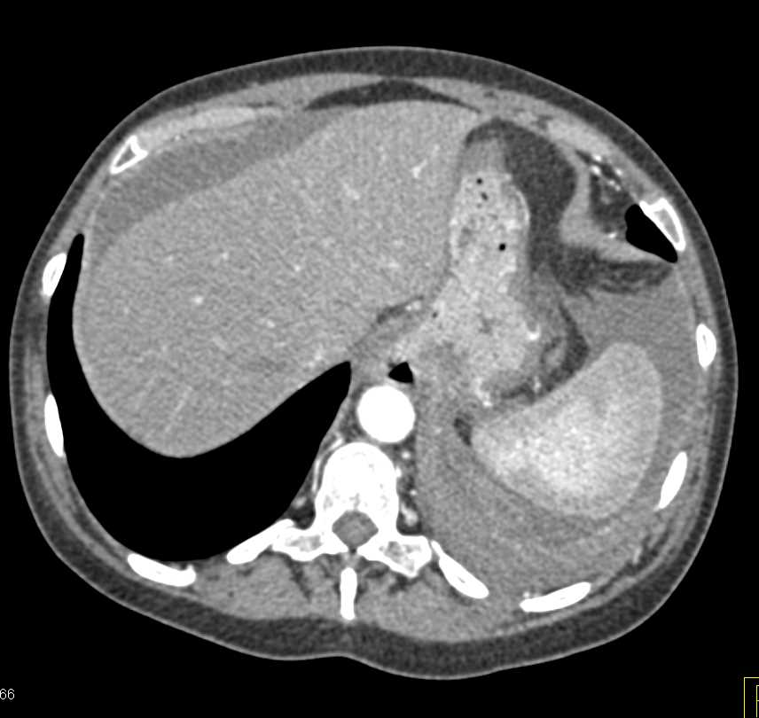 Left Adrenal Bleed with Hemoperitoneum - CTisus CT Scan