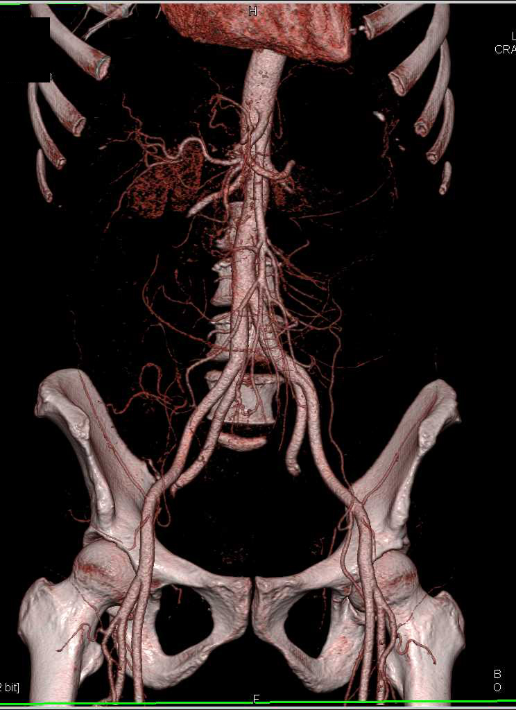 2cm Pheochromocytoma at Aortic Bifurcation (organ of Zuckerkandl) - CTisus CT Scan