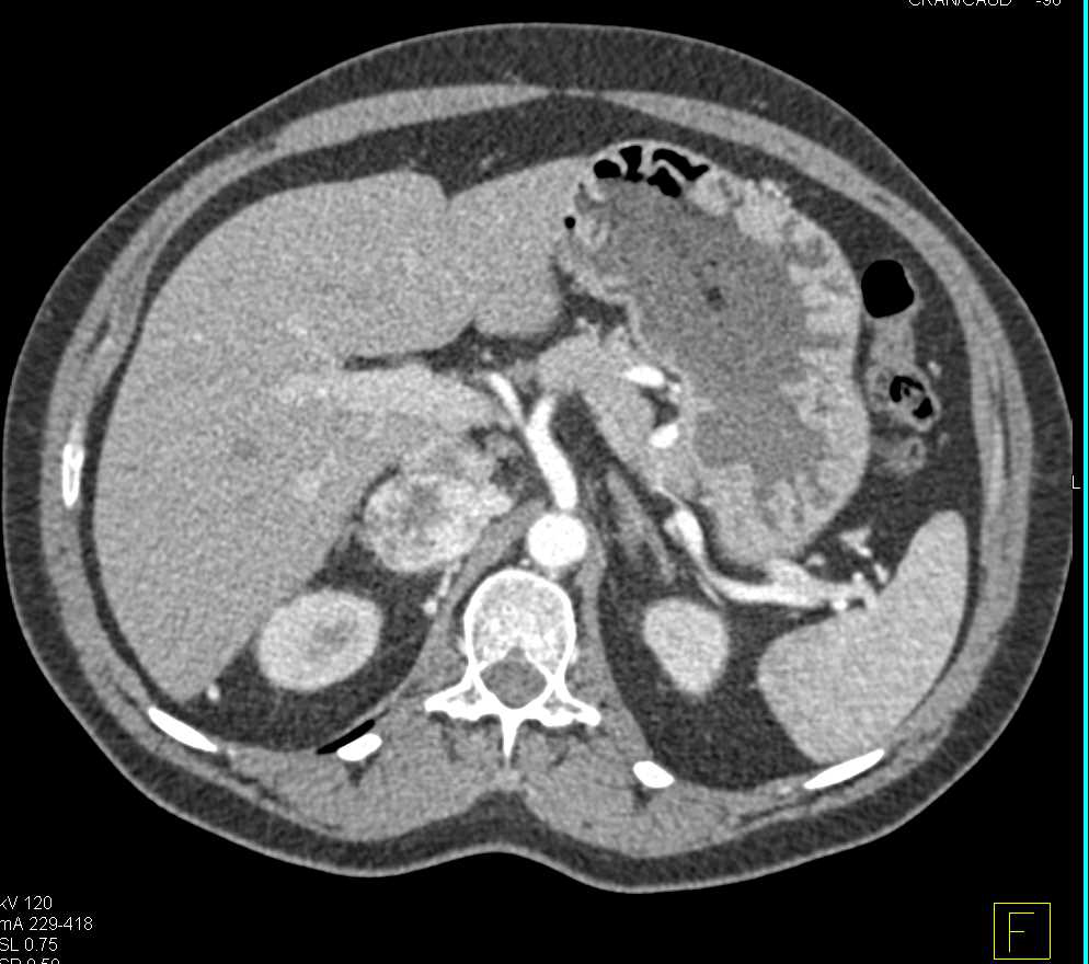 Pheochromocytoma on CT and I-123 MIBG Study - CTisus CT Scan