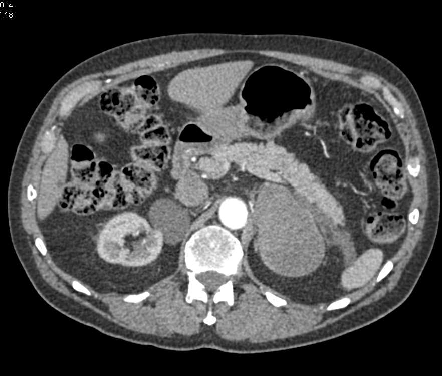 Old Left Adrenal Hematoma Looks Like a Concerning Tumor - CTisus CT Scan