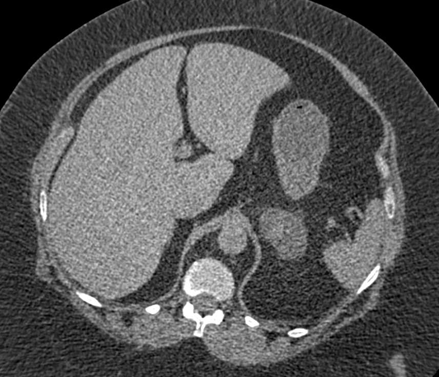 Left Adrenal Myelolipoma - CTisus CT Scan