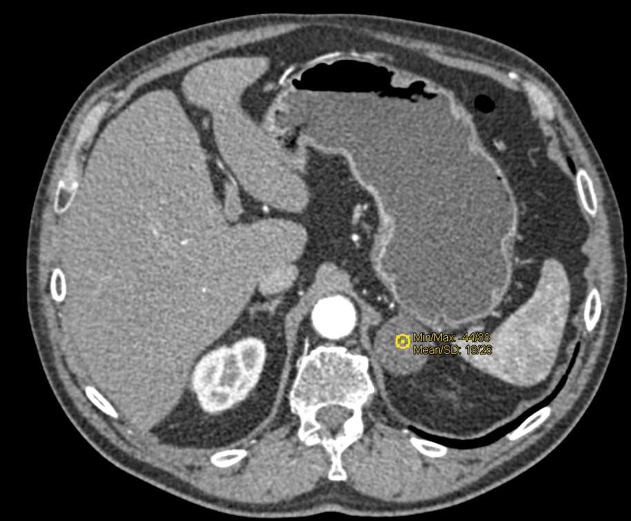 Left Adrenal Adenoma - CTisus CT Scan