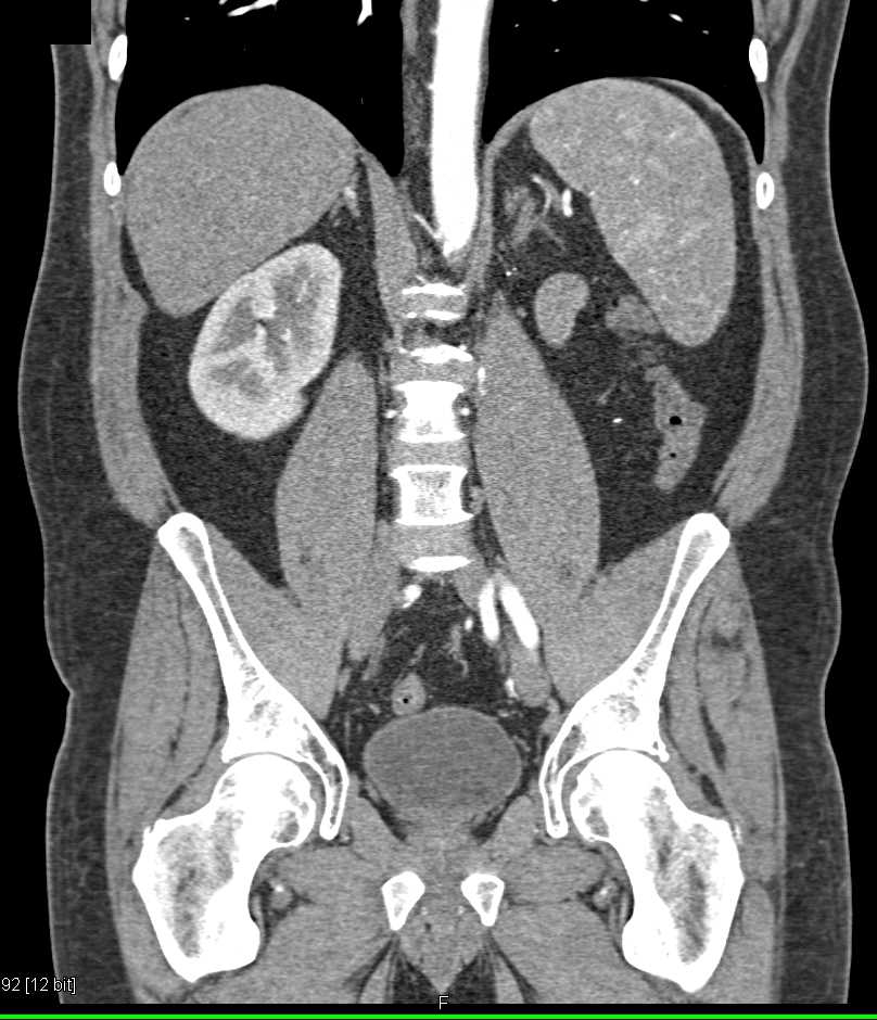 Subtle Right Adrenal Metastases from Renal Cell Carcinoma - CTisus CT Scan