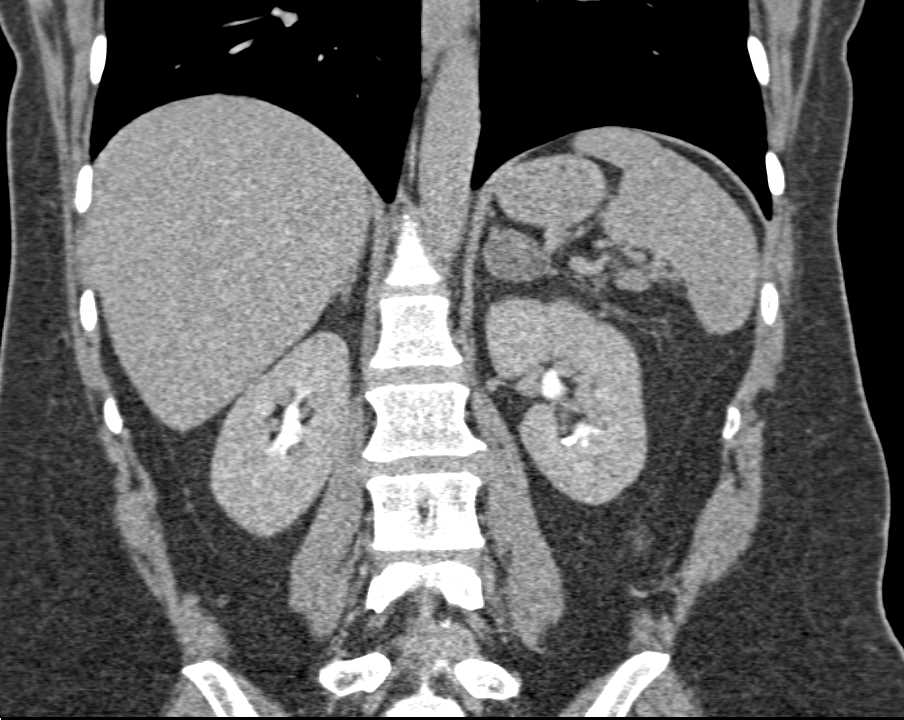 Left Adrenal Adenoma - CTisus CT Scan