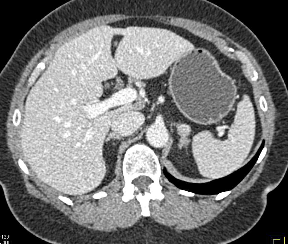 Left Adrenal Adenoma - CTisus CT Scan