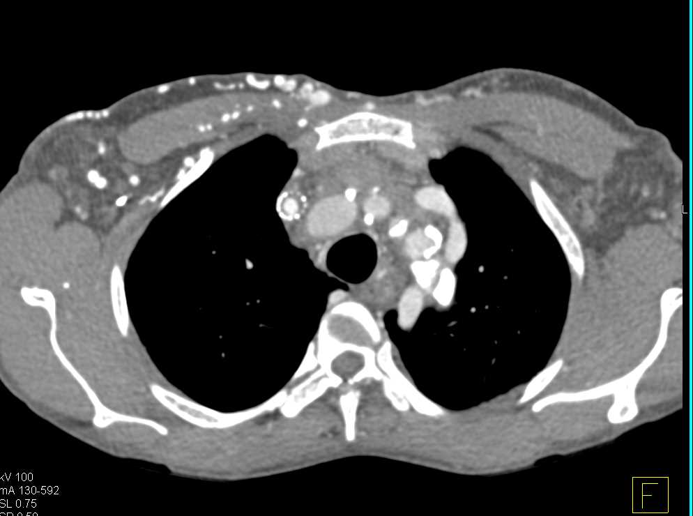 Stent in Right Innominate Vein That is Occluded with Collaterals in Chest Wall - CTisus CT Scan