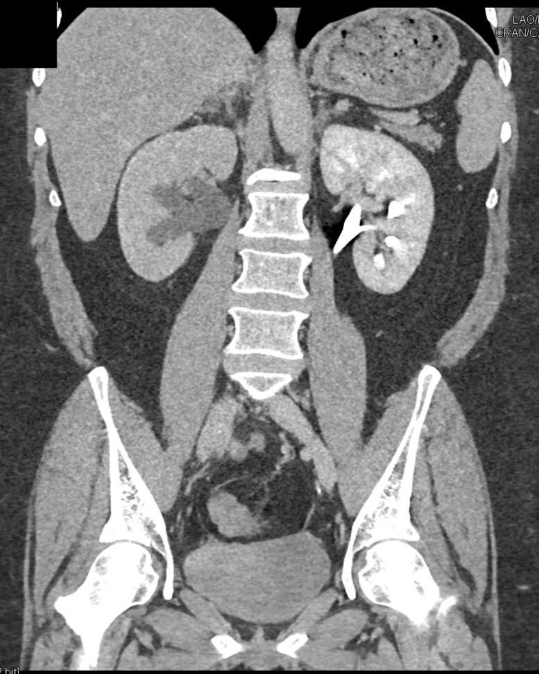 Incidental Right Adrenal Hematoma - CTisus CT Scan