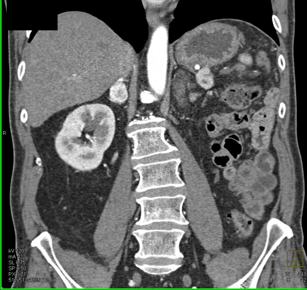 Metastatic Renal Cell Carcinoma to Right Adrenal Gland - CTisus CT Scan