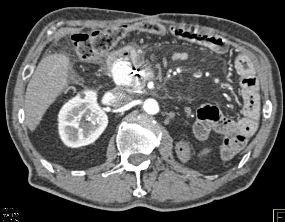 Metastatic Renal Cell Carcinoma to Right Adrenal Gland and the Pancreas - CTisus CT Scan