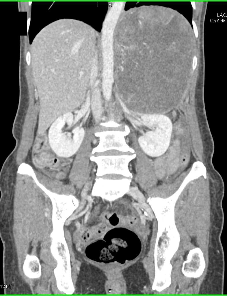 Left Adrenal Carcinoma with Hemorrhage - CTisus CT Scan