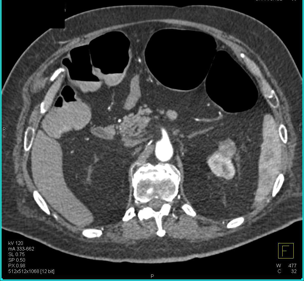 Angiomyolipoma (AML) Right Adrenal Gland - CTisus CT Scan