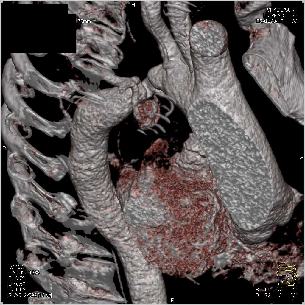 Coarctation of the Aorta with Dilated Internal Mammary Arteries and Other Collaterals - CTisus CT Scan