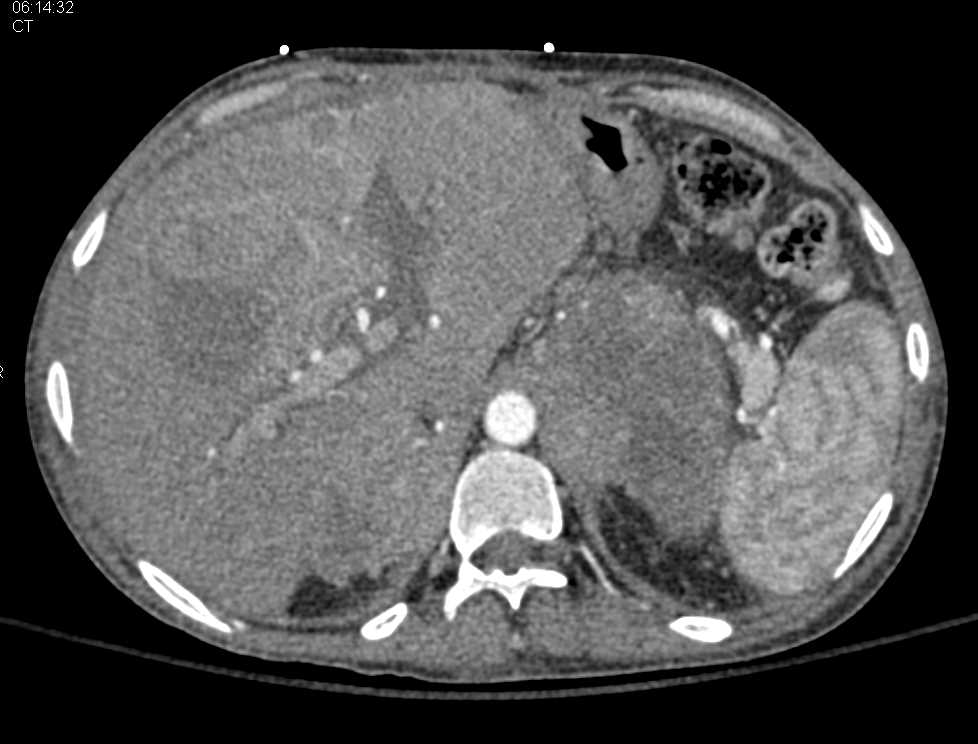 Bilateral Adrenal Metastases with Metastatic Melanoma - CTisus CT Scan