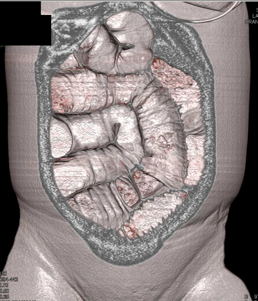 Ischemic Bowel in a Patient with Poor Cardiac Function - CTisus CT Scan