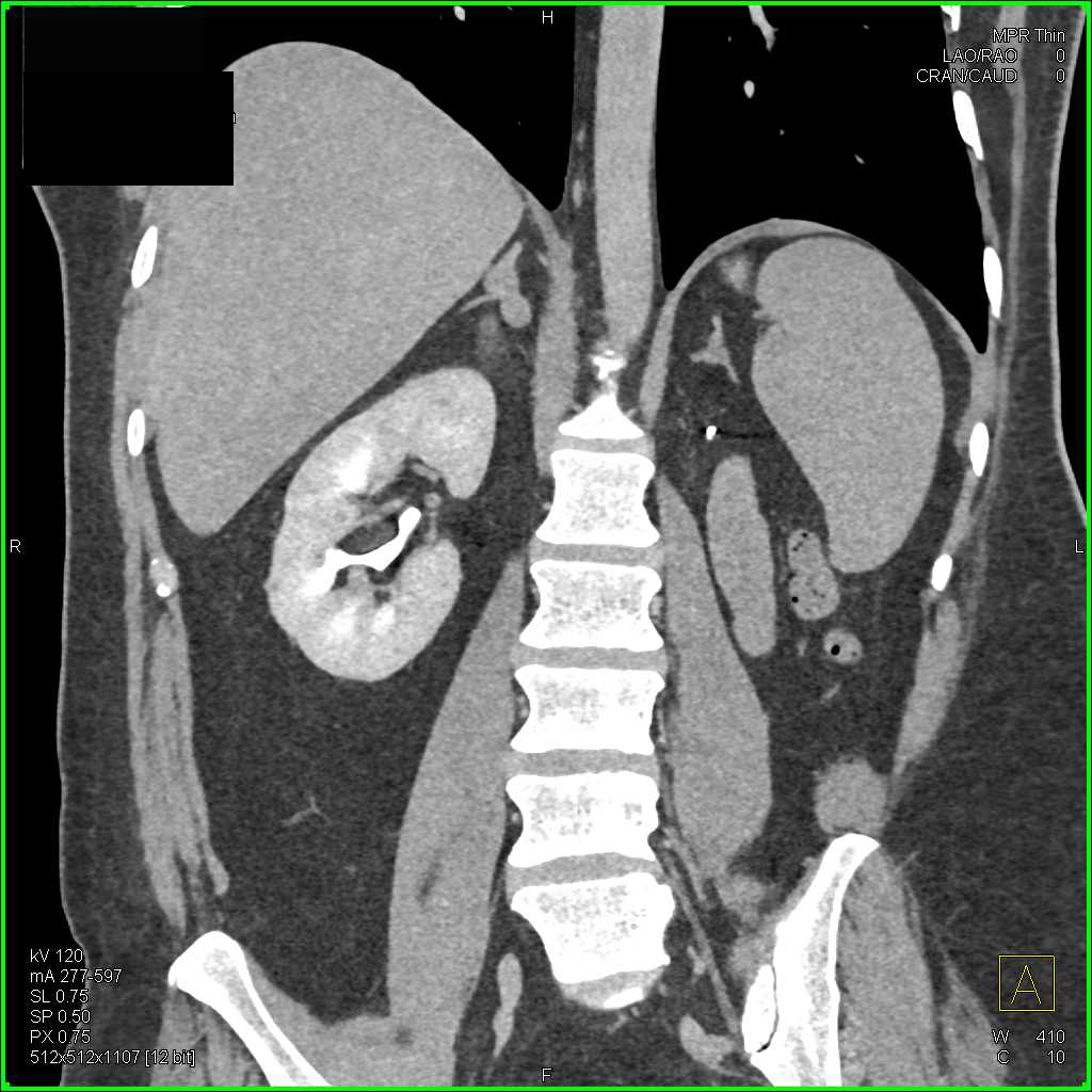 Multiple Right Adrenal Nodules - CTisus CT Scan