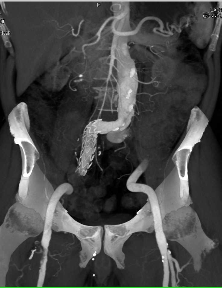 Proximal Superficial Femoral Artery (SFA) Stenosis - Adrenal Case