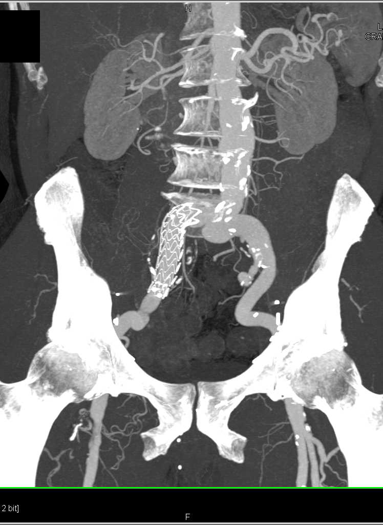 Proximal Superficial Femoral Artery (SFA) Stenosis - CTisus CT Scan