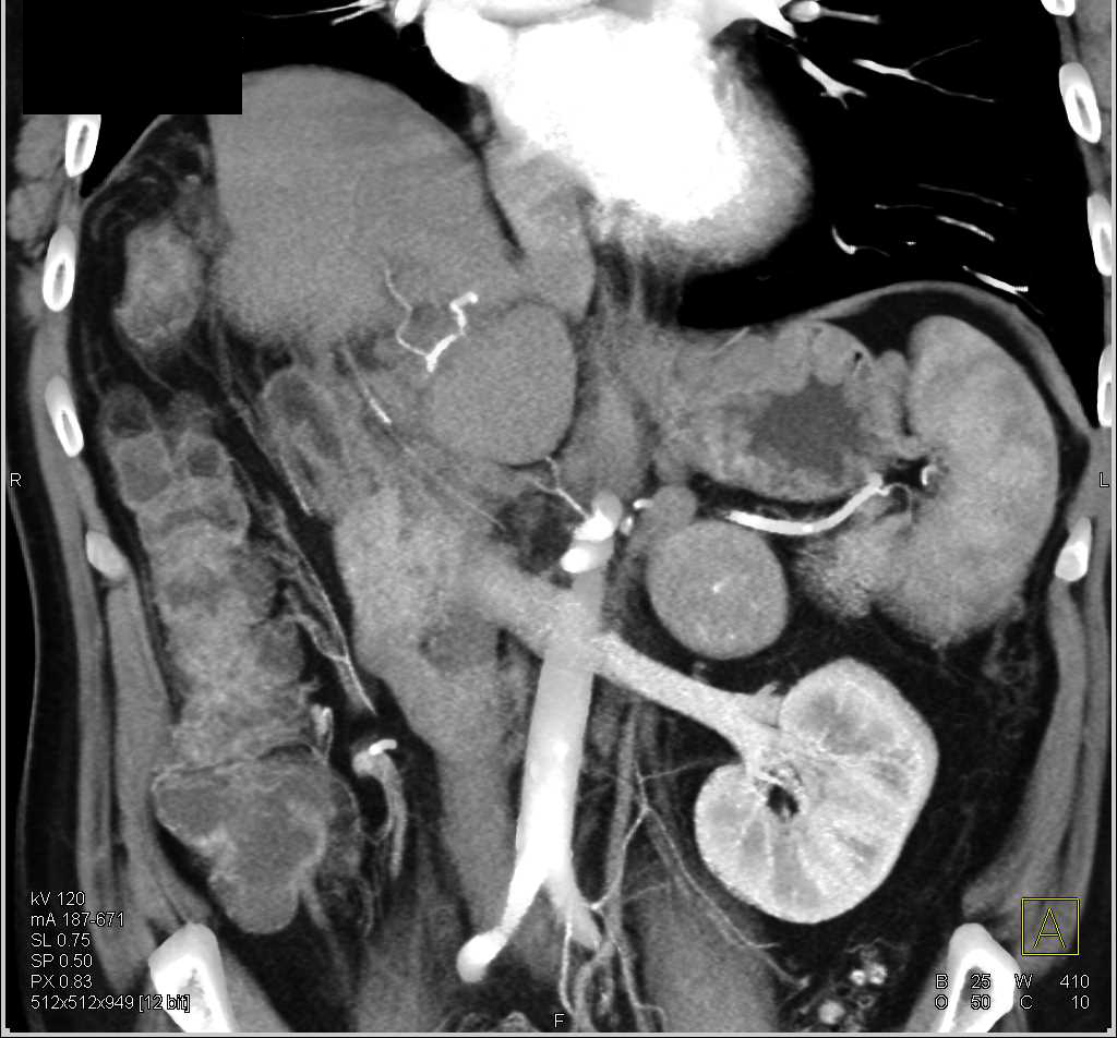 Adrenal Metastases from Hepatocellular Carcinoma (Hepatoma) That Was Resected - CTisus CT Scan