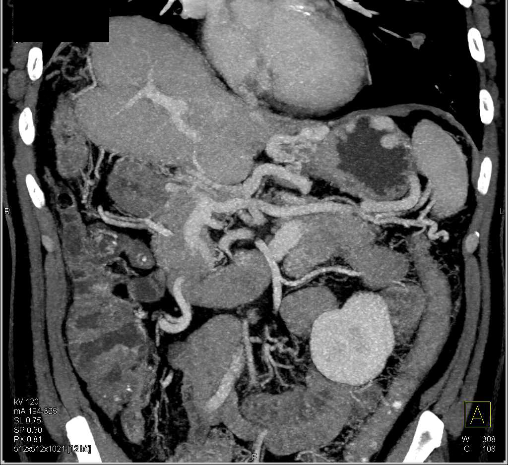 Adrenal Metastases from Hepatocellular Carcinoma (Hepatoma) That Was Resected - CTisus CT Scan