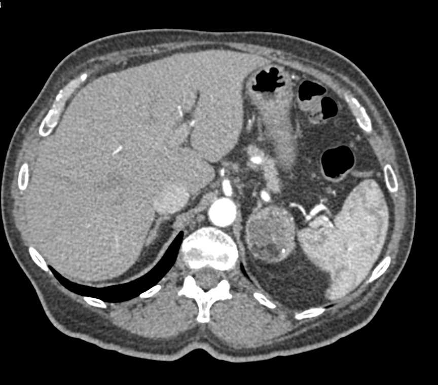 Left Adrenal Myelolipoma - CTisus CT Scan