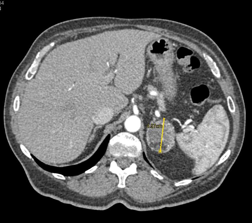 Left Adrenal Myelolipoma - CTisus CT Scan