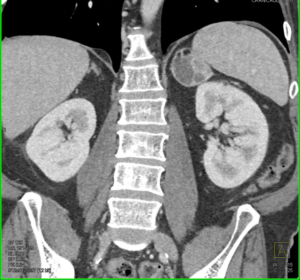 Left Adrenal Myelolipoma - Adrenal Case Studies - CTisus CT Scanning