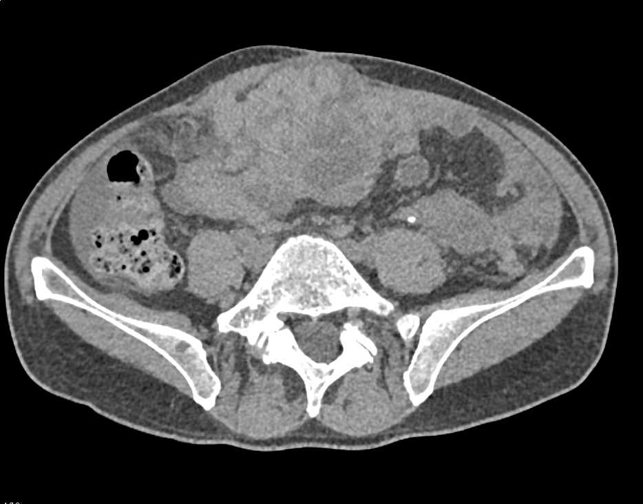 Metastatic Renal Cell Carcinoma with Carcinomatosis - CTisus CT Scan