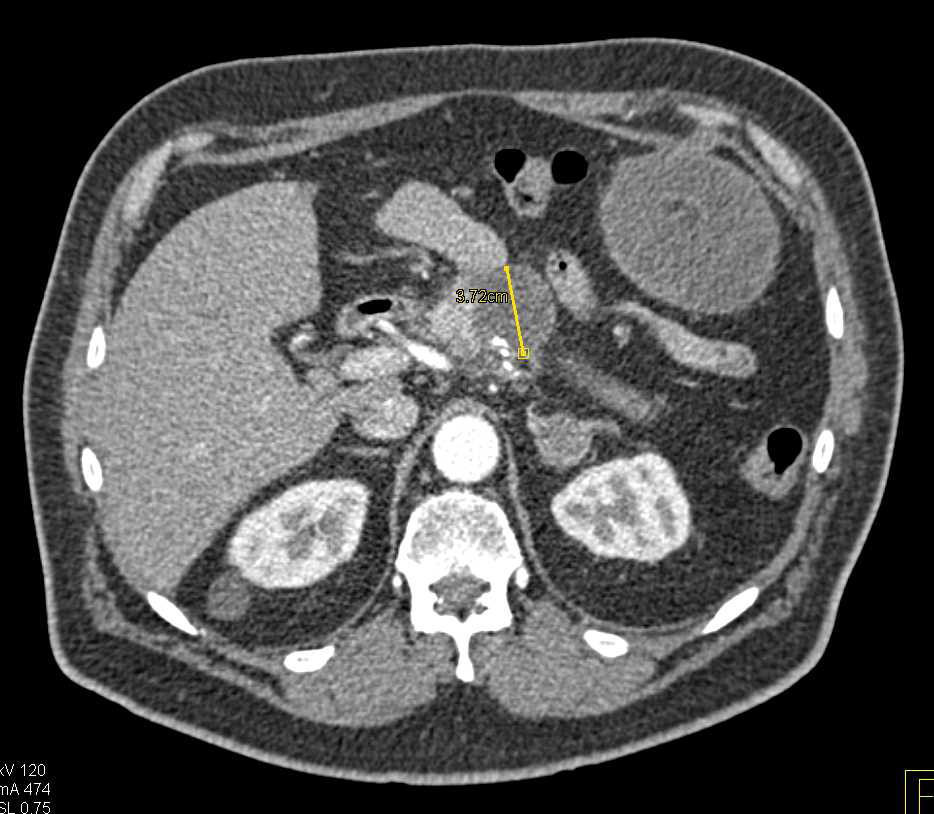 Omental Infarct Left Upper Quadrant after Distal Pancreatectomy and Splenectomy - CTisus CT Scan