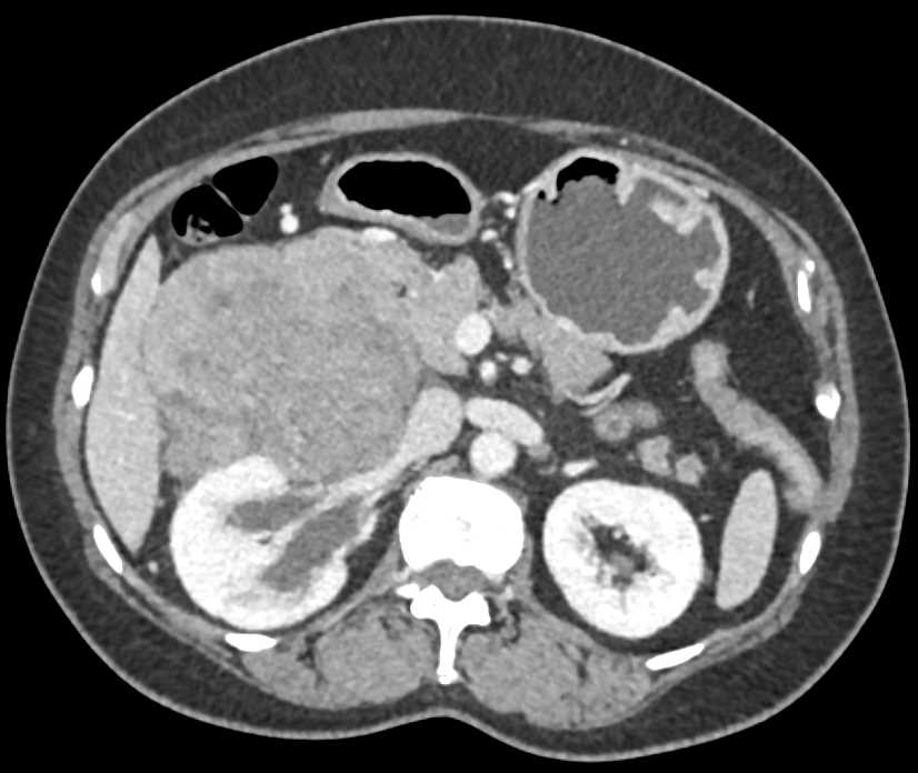 Primary Adrenal Carcinoma - CTisus CT Scan