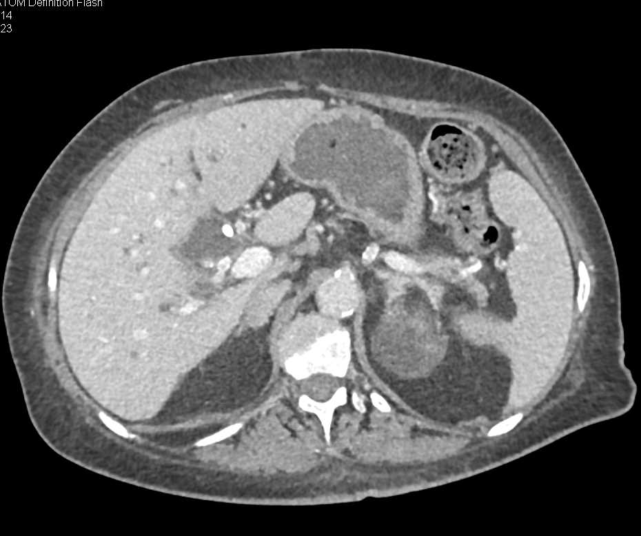 Left Adrenal Myelolipoma - CTisus CT Scan