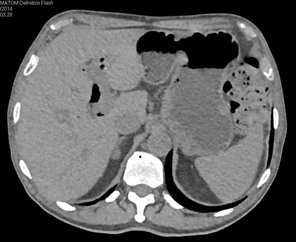 Small Pheochromocytoma Right Adrenal Gland - CTisus CT Scan