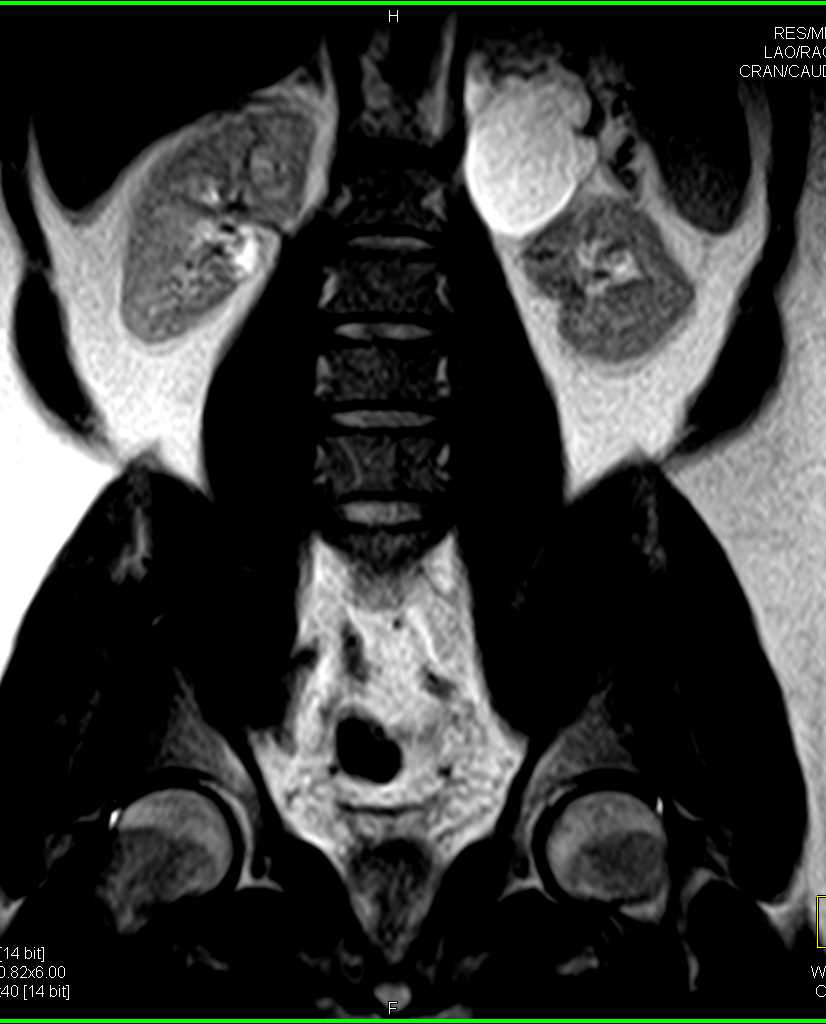 Pheochromocytoma Left Adrenal - CTisus CT Scan