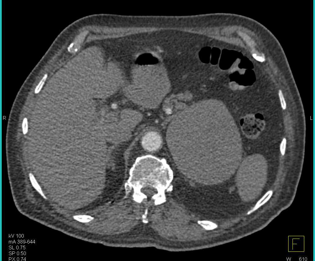 Unusual Pheochromocytoma Left Adrenal with Little Vascularity - CTisus CT Scan