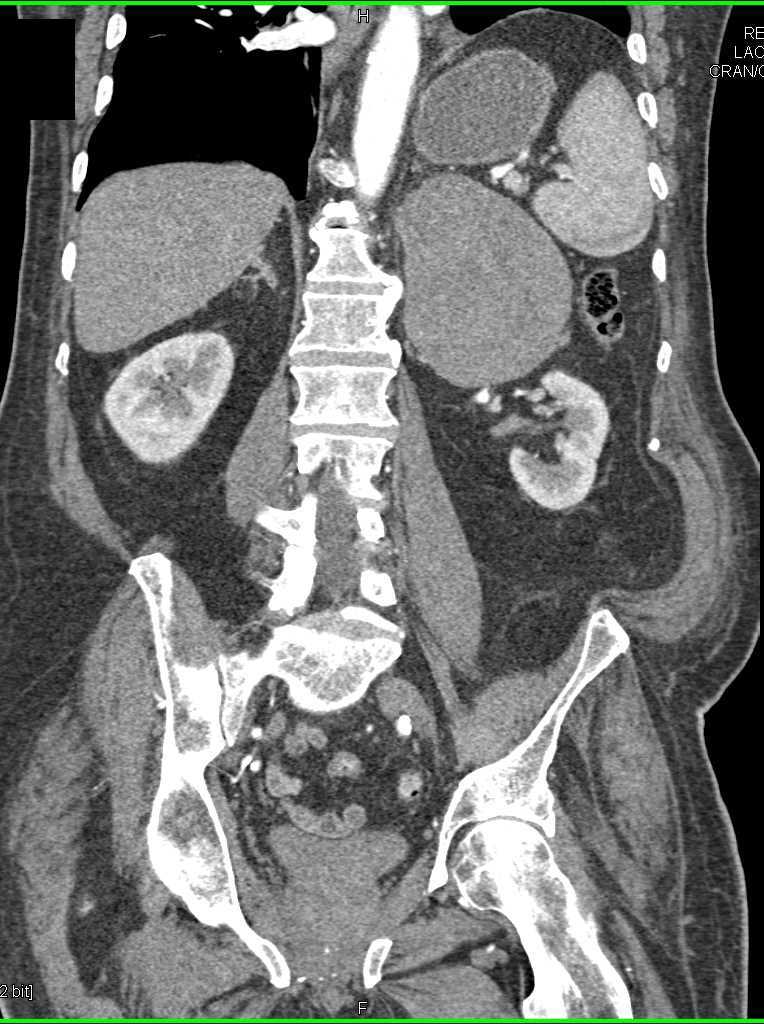 Adrenal Carcinoma - CTisus CT Scan