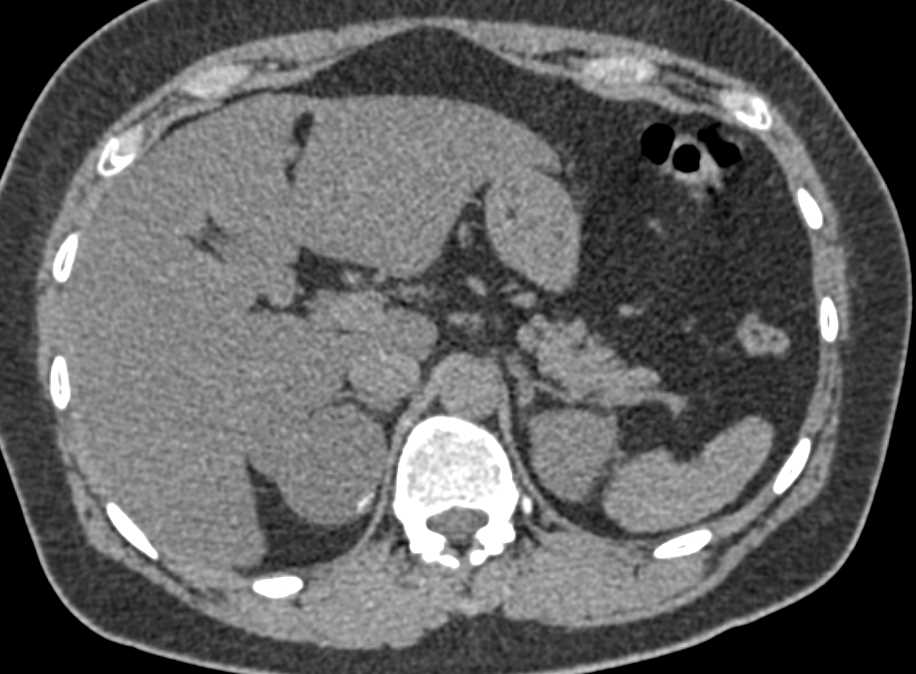 Right Adrenal Lymphangioma - CTisus CT Scan