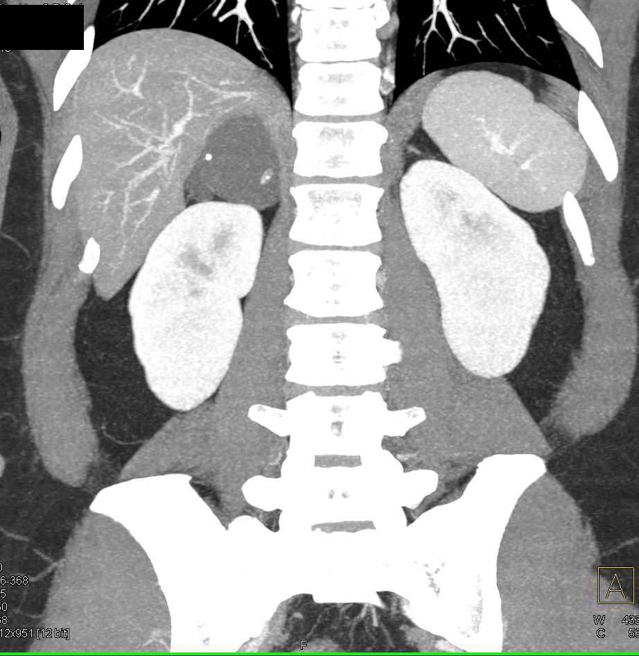 Right Adrenal Lymphangioma - CTisus CT Scan