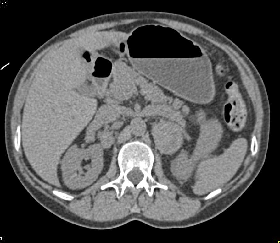 Cystic Renal Cell Carcinoma with Left Adrenal Metastases - CTisus CT Scan