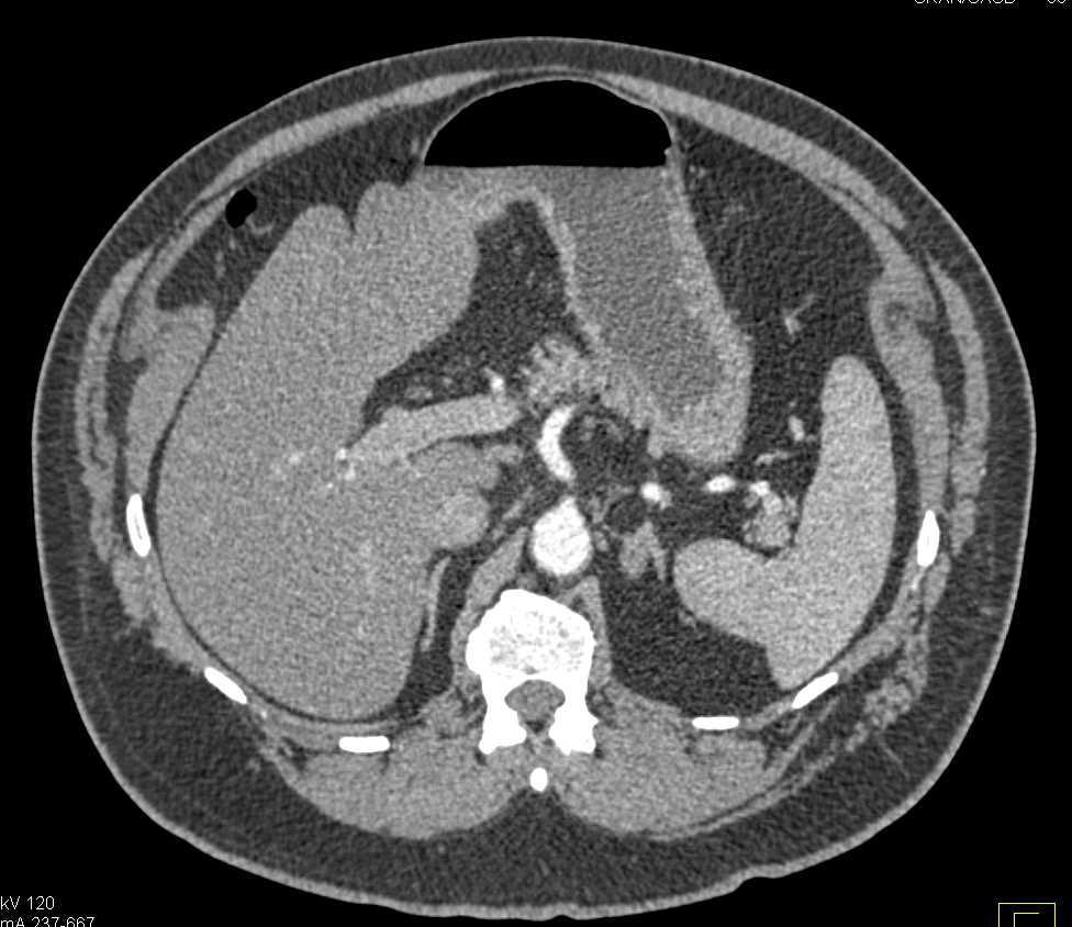 Adrenal Myelolipoma Left Adrenal Gland - CTisus CT Scan