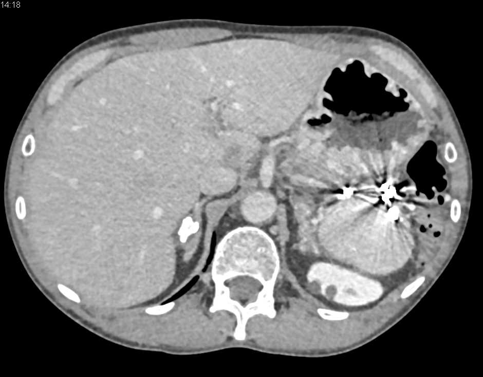 Adrenal Calcifications due to Prior Inflammation - CTisus CT Scan