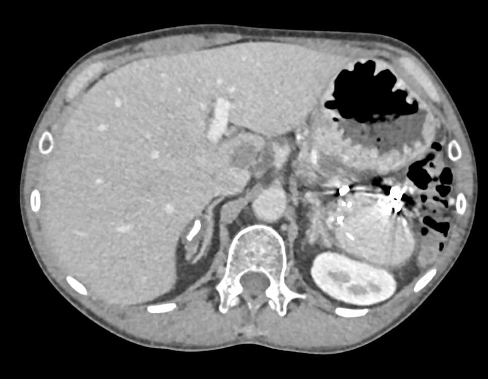 Adrenal Calcifications due to Prior Inflammation - Adrenal Case Studies