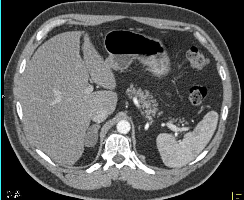 Right Adrenal Adenoma - CTisus CT Scan