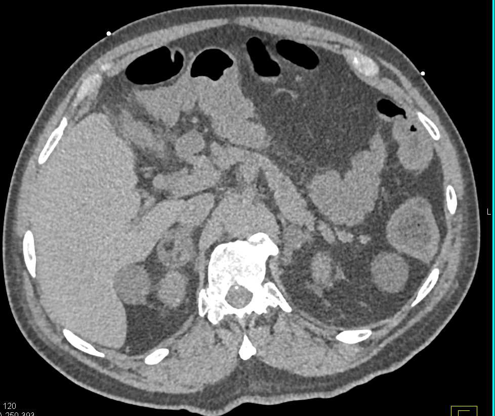 Incidental Adrenal Myelolipoma - CTisus CT Scan