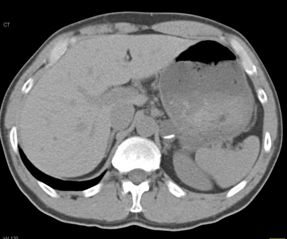 Partially Calcified Adrenal Hematoma - CTisus CT Scan