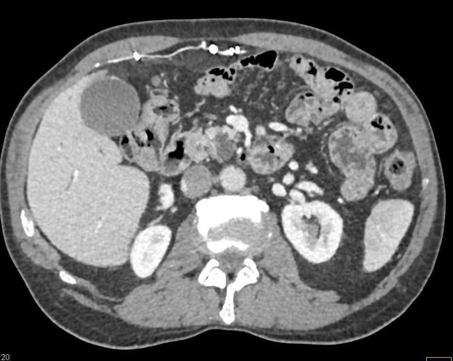 Incidental Pheochromocytoma and Intraductal Papillary Mucinous Neoplasms (IPMNs) - CTisus CT Scan