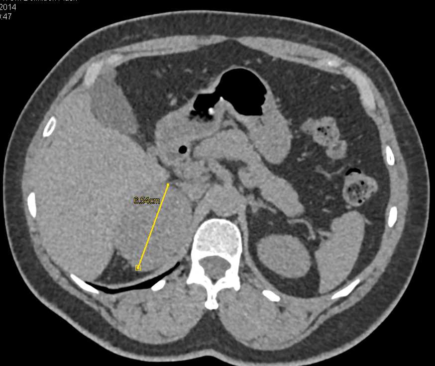 Unusual Adrenal Adenoma - CTisus CT Scan