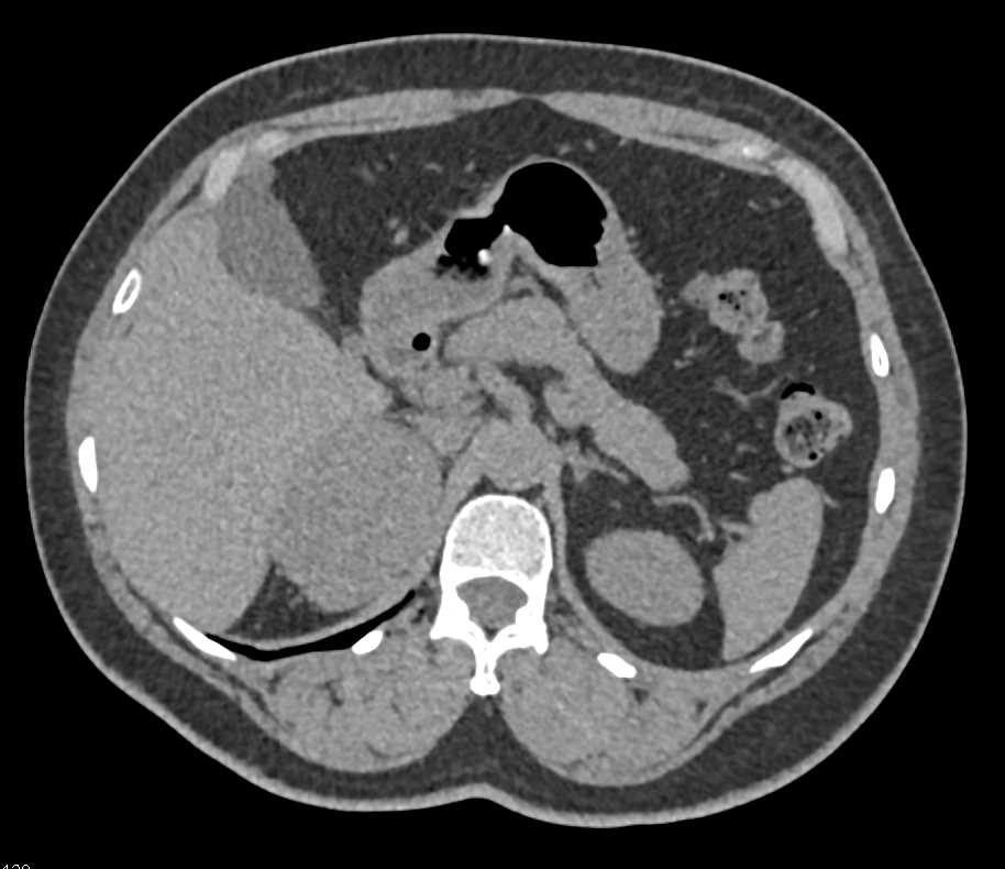 Unusual Adrenal Adenoma - CTisus CT Scan